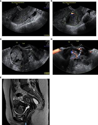 Case report: Spontaneous remission of synchronous endometrial and ovarian cancers following pregnancy